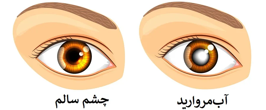 آب‌مروارید