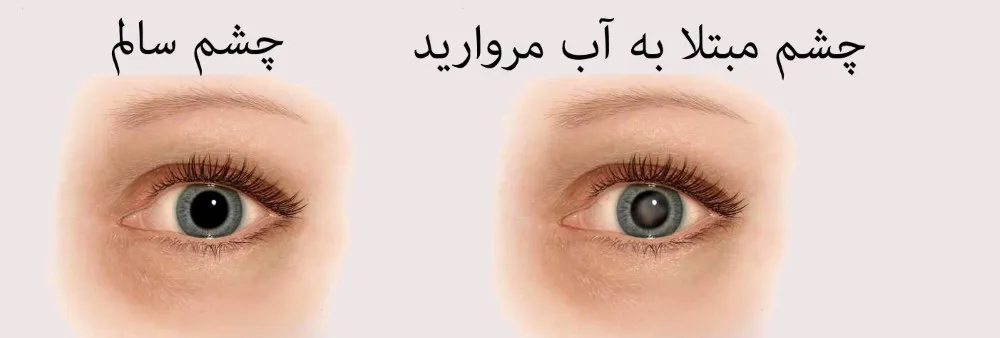 بیماری‌های چشم که به سن مربوط می‌شوند