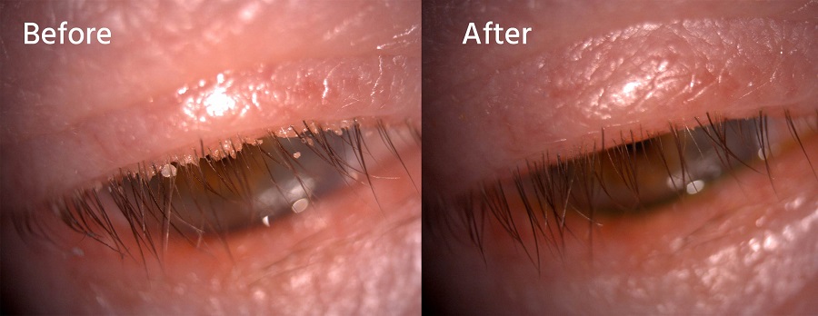 چه کسانی نباید از لنز تماسی استفاده کنند؟