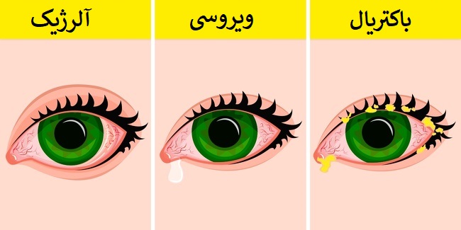 درمان عفونت چشم