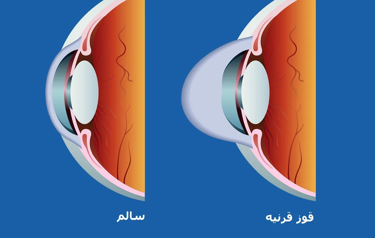 بیماری قوز قرنیه چیست؟