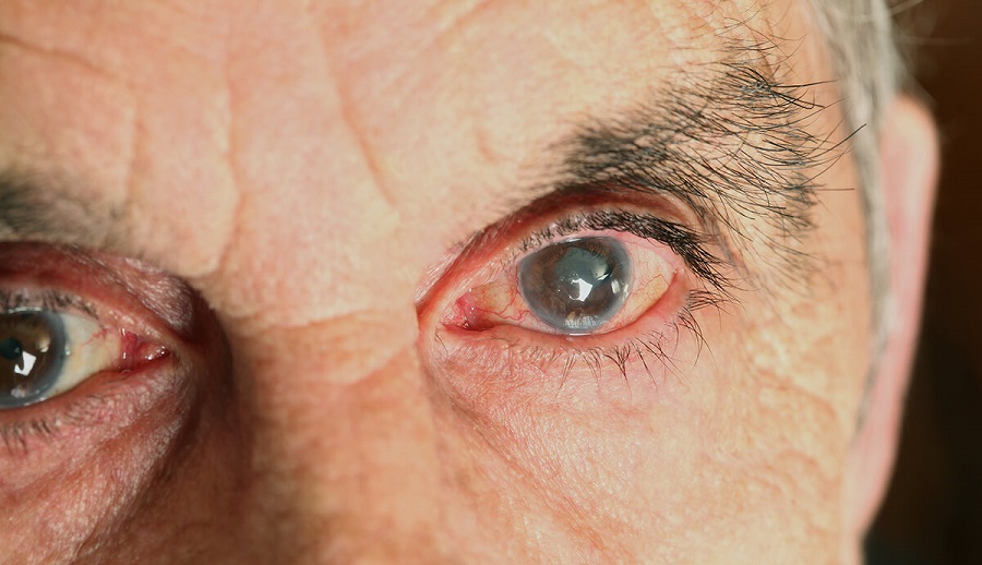 علت شکل گیری آب مروارید