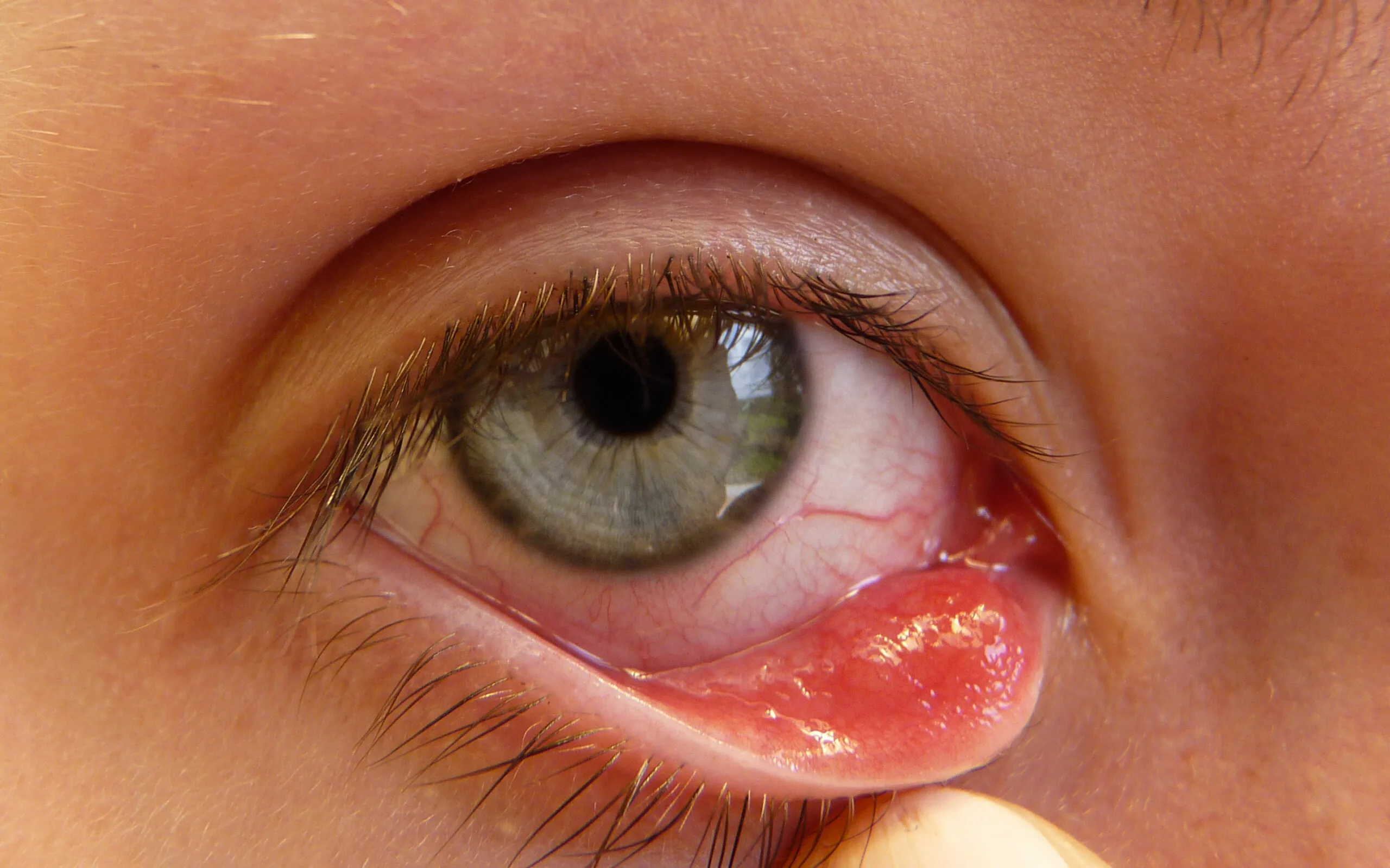 شالازیون چیست ؟ chalazion