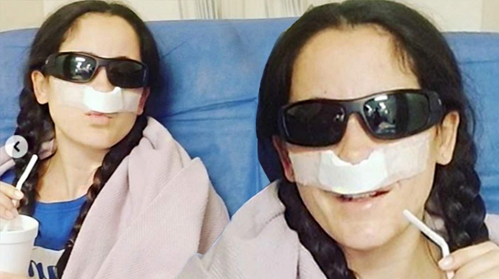 عینک آفتابی بعد از عمل بینی