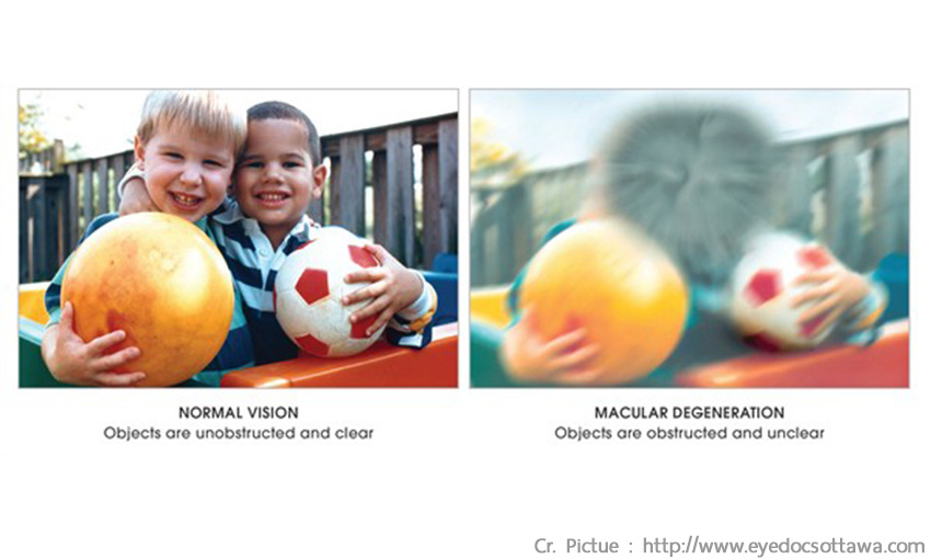 پیشگیری از تخریب ماکولا