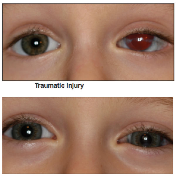 لنز بلک پوپیل