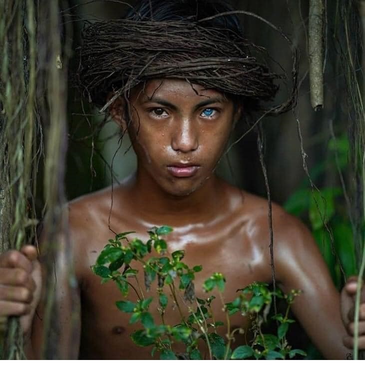 سندرم واردنبرگ