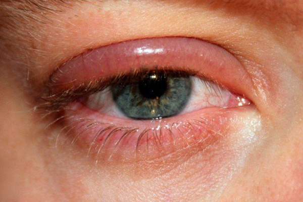 بلفاریت چشم