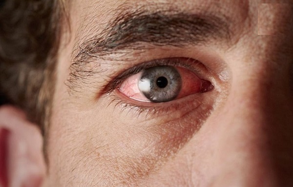 بیماری گلوکوم یا آب سیاه