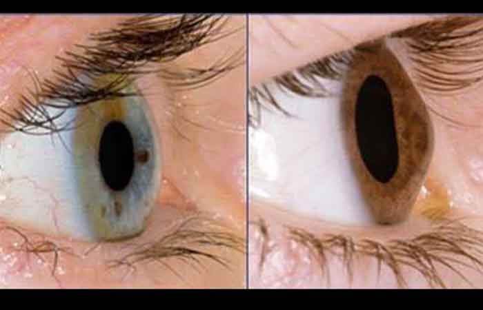 بیماری قوز قرنیه