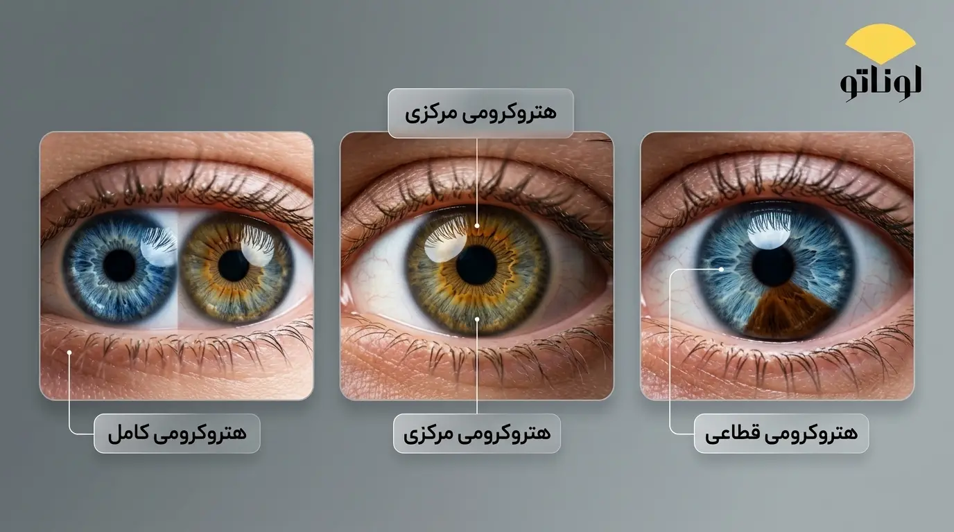 انواع هتروکرومیا
